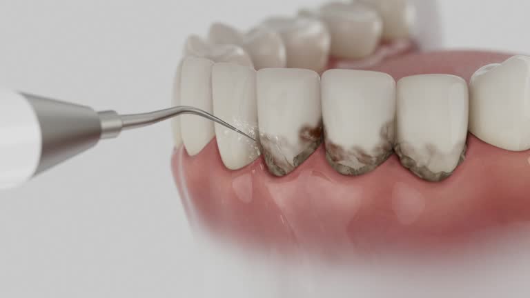 Trusted Dental Implants service in Burien, WA - Dentist Open Now